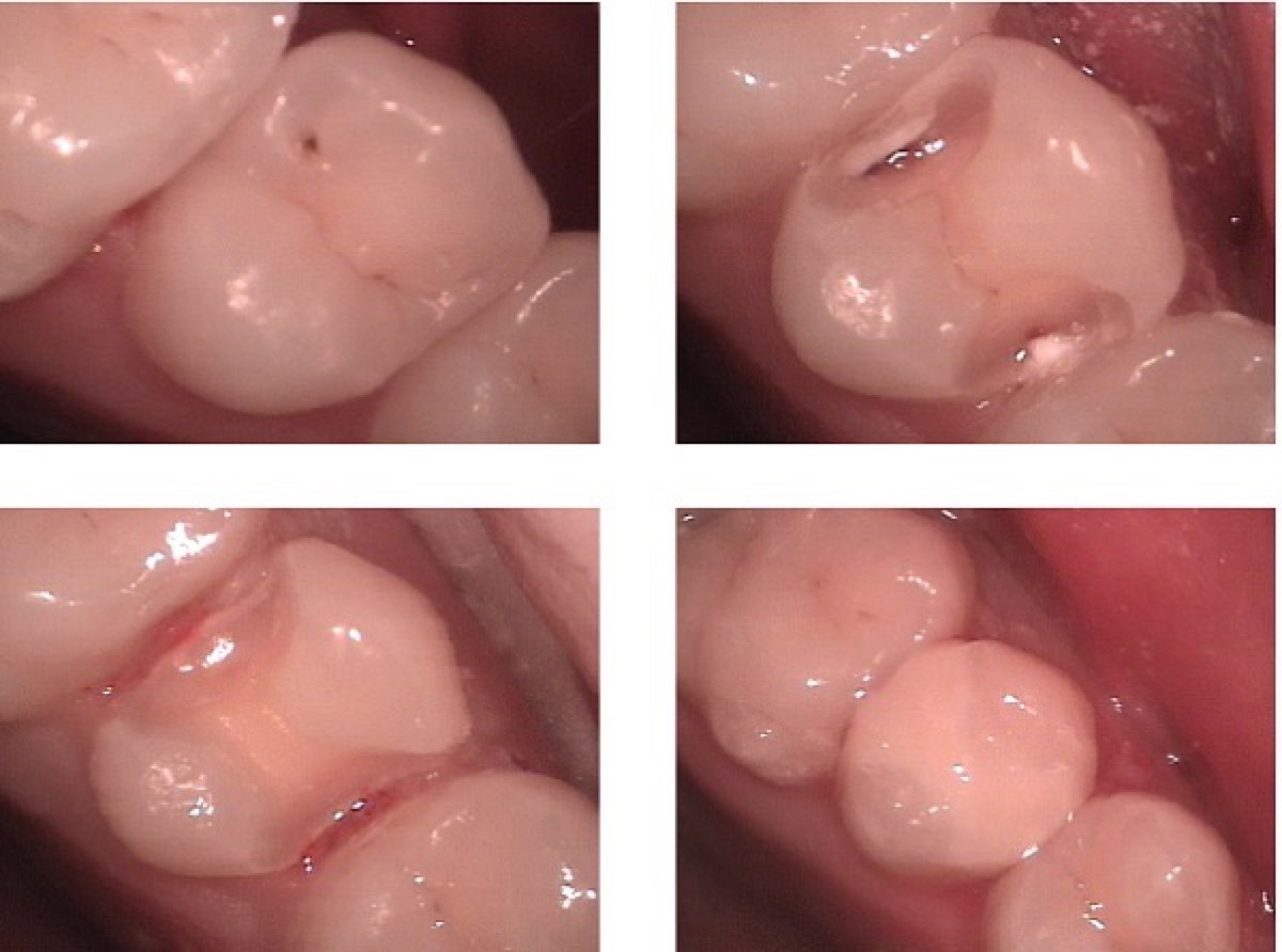 Restauración dental con resina compuesta