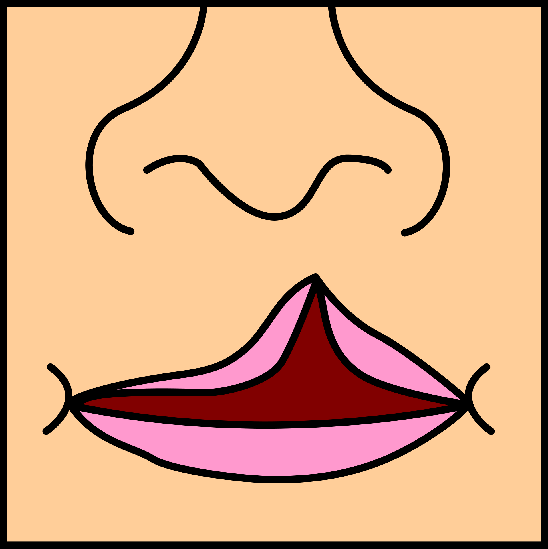 Esquema de labio hendido unilateral: la hendidura sube del labio superior hacia la narina de ese lado.