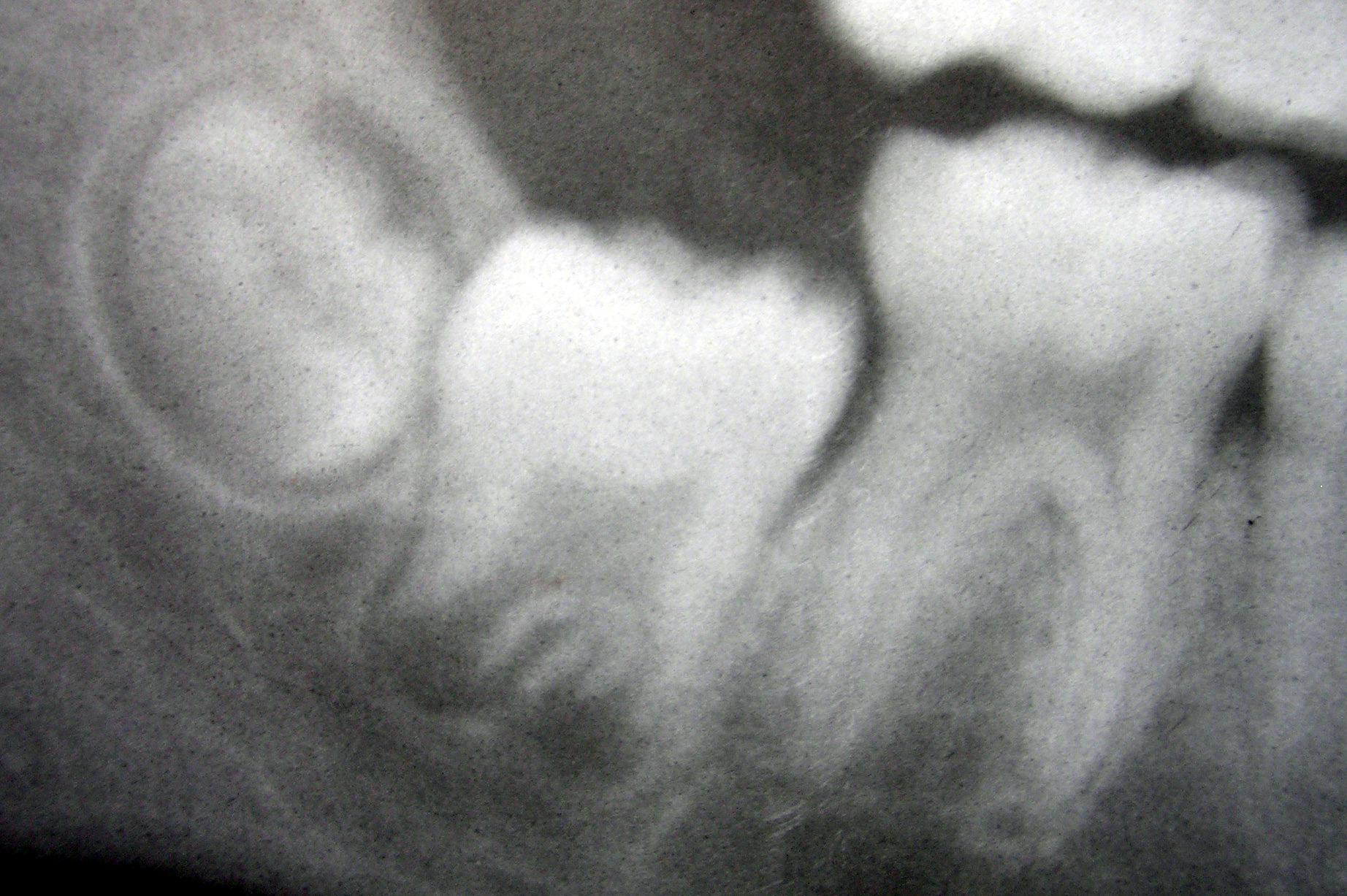 Radiografía periapical de molares inferiores donde se ve un tercer molar en formación con la corona hecha y las raíces incompletas.