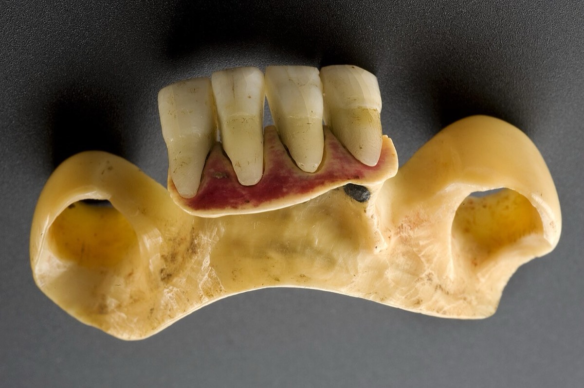 Prótesis inferior con dientes humanos sobre base de marfil